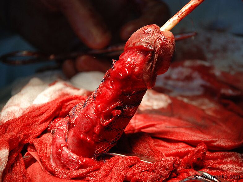 penis büyütme için kollajen matrisinin yerleştirilmesi