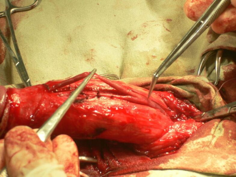 penisin büyütülmesi için lipofilik dolgu yapılması