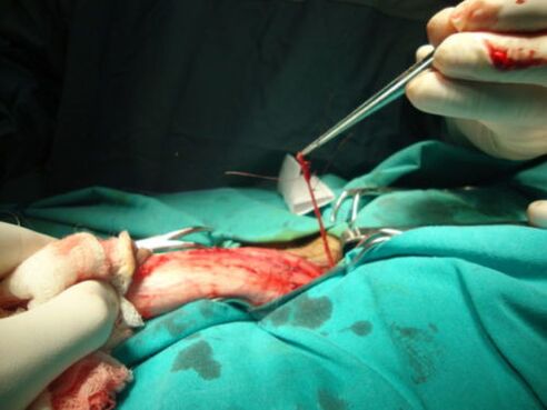 penis büyütme ameliyatı