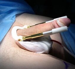 Penis büyütme ameliyatı nasıl yapılır