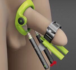 penis büyütme ameliyatı sonrası rehabilitasyon